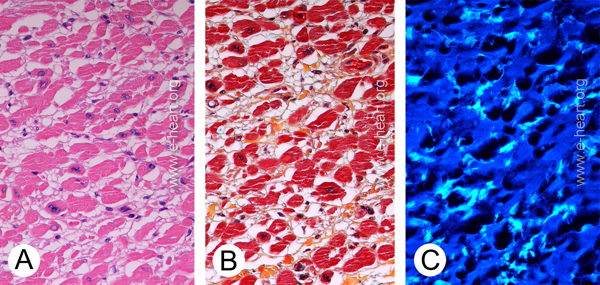 Isolated atrial amyloidosis